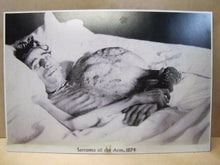 Load image into Gallery viewer, Old Medical Science Photo &quot;Sarcoma of the Arm 1874&quot; Burns Archive NY Print
